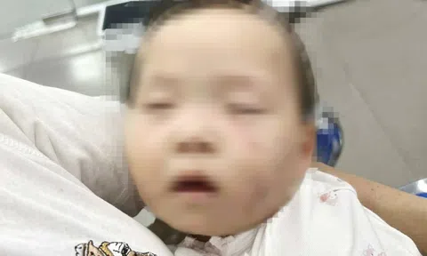 Tạm giữ nữ giáo viên trong vụ bé gái có nhiều vết bầm tím chi chít trên mặt