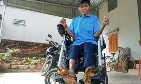 Cuộc sống của người đàn ông mắc bệnh 'người cây' hiếm gặp ở Ninh Bình