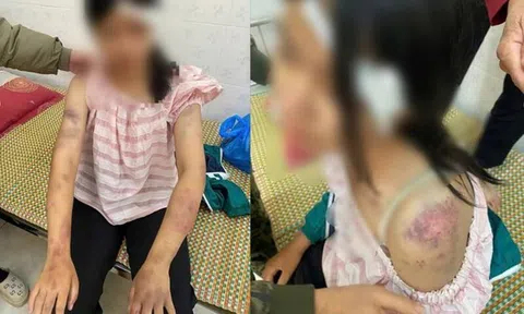 Thông tin mới vụ bé gái 13 tuổi bị tra khảo, đánh đập dã man, người chi chít vết thương