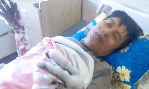 Một công nhân bị bỏng nặng 2 tay do phóng điện