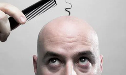 Quốc gia nào có nhiều người hói nhất thế giới?