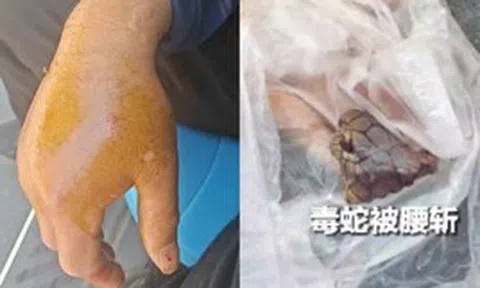 Bị rắn hổ mang chúa dài 2 mét cắn, người đàn ông chém đứt xác rắn rồi đến bệnh viện