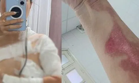 Đi gội đầu dưỡng sinh, cô gái nhận "combo sự cố": Bỏng độ 2, cấp cứu xuyên đêm vì nồi xông hơi phát nổ?