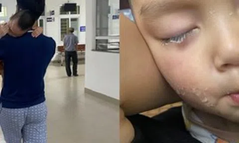 Suýt hối hận cả đời vì vài phút lơ đễnh: Lại thêm 1 em bé bị keo 502 dính vào mắt