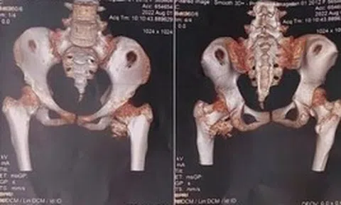 Bé gái 12 tuổi mắc "hội chứng người hóa đá hiếm gặp", bố mẹ ngỡ ngàng khi bác sĩ nhắc tới cú ngã xe đạp 2 năm trước