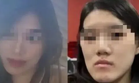 Cô gái bị biến dạng khuôn mặt sau PTTM, bi kịch đau khổ vì quyết định sai lầm