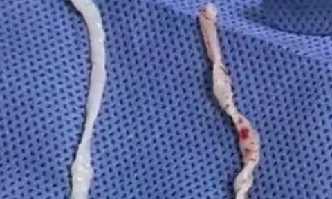 Đau cánh tay suốt một năm, người phụ nữ bàng hoàng khi bác sĩ phát hiện hai sinh vật dài 10cm đang sống dưới da