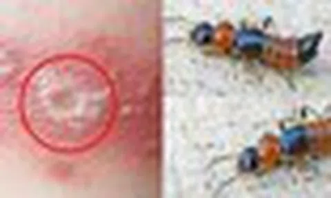 5 bước xử lý đúng cách khi tiếp xúc với kiến 3 khoang