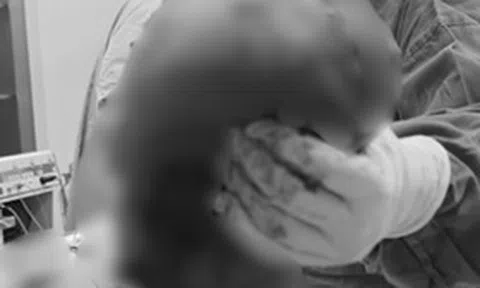 Bé gái 14 tuổi có vùng mông to bất thường, sự thật phía sau khiến gia đình "sốc ngang"