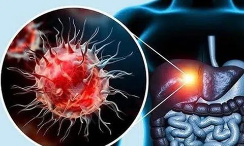 Không rượu bia, gan vẫn có thể tổn thương nặng vì lý do ít ai ngờ