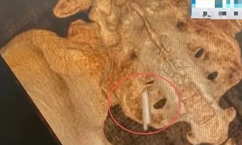 Đi khám sức khỏe, cô gái sốc khi phát hiện thứ "bất ngờ" nằm trong cơ thể suốt 22 năm
