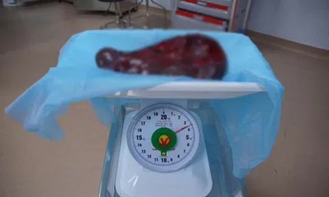 Bụng người đàn ông 69 tuổi ngày càng phình to, bác sĩ sững sờ khi phát hiện thứ "khổng lồ" bên trong