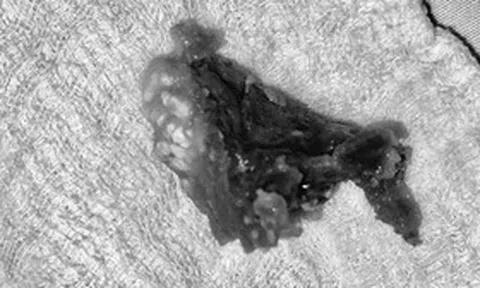 Người đàn ông 72 tuổi nhập viện vì sự cố hi hữu khi ăn bún bò