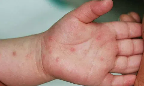 Tp.HCM ghi nhận số ca tay chân miệng tăng 47% trong một tuần