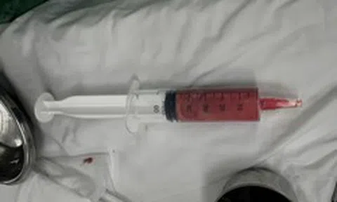 Bệnh viện Trung ương Quân đội 108 cảnh báo những người tiêm filler 5-10 năm trước