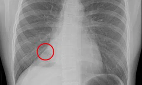 Bé 13 tuổi ho mãi không thôi, bác sĩ phát hiện thứ "đáng sợ" bên trong