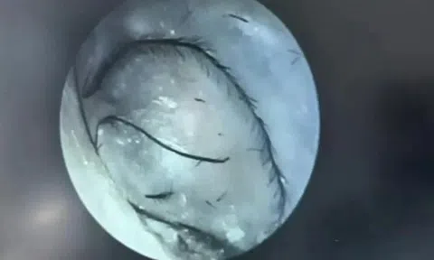 Người phụ nữ ngứa tai đi khám, bác sĩ phát hiện thứ bất ngờ bên trong