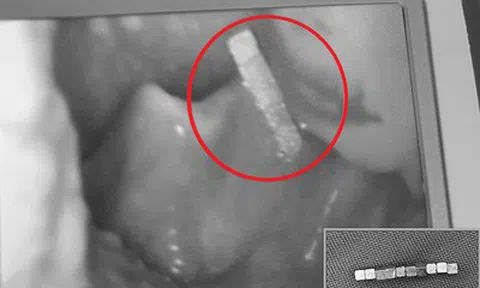 Bé trai gần 4 tuổi khó chịu ở cổ, bố mẹ kinh ngạc khi bác sĩ gắp ra thứ "đáng sợ" bên trong