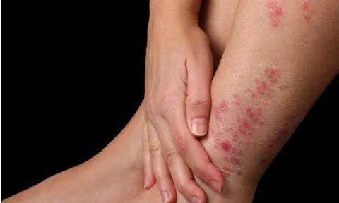 Bật mí nguyên nhân và cách điều trị bệnh vảy nến ở chân