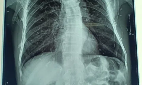 Cụ ông 70 tuổi đi khám răng phát hiện sán lúc nhúc toàn thân