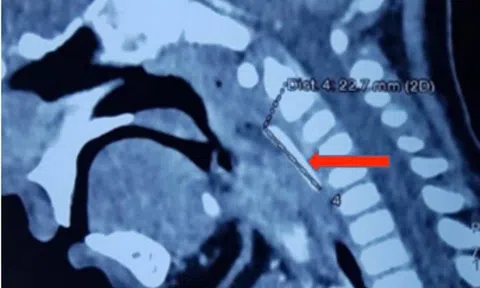 Đang đùa nghịch, bệnh nhi 18 tháng tuổi bị cây nĩa nhựa đâm xuyên họng